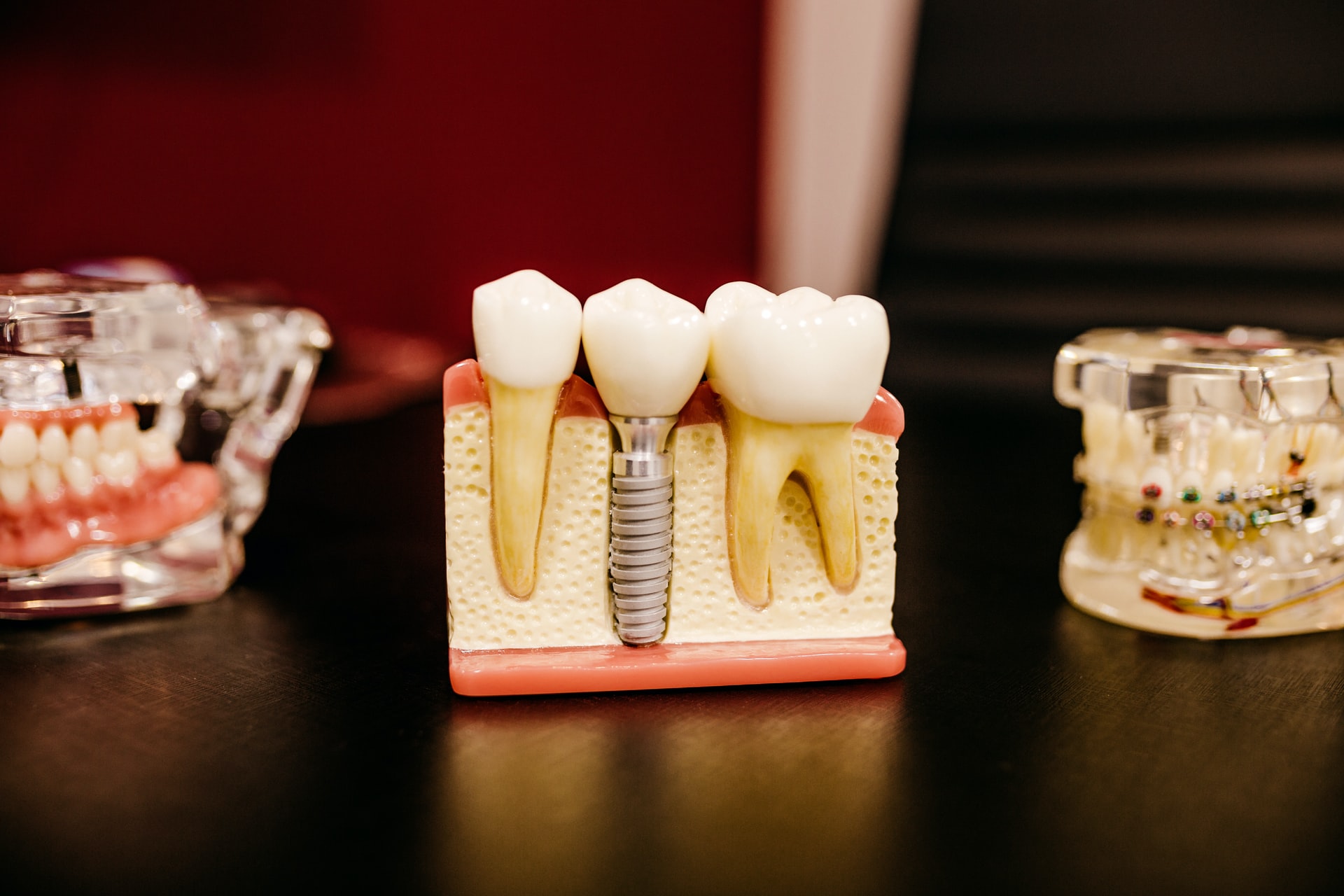 What are Wisdom Teeth and When Should They Be Removed?