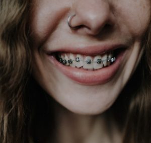 Why Should I Go For Clear Braces?